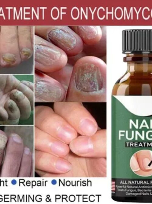 Fast Nail Fungal Treatments Nail Repair Essences Serum
